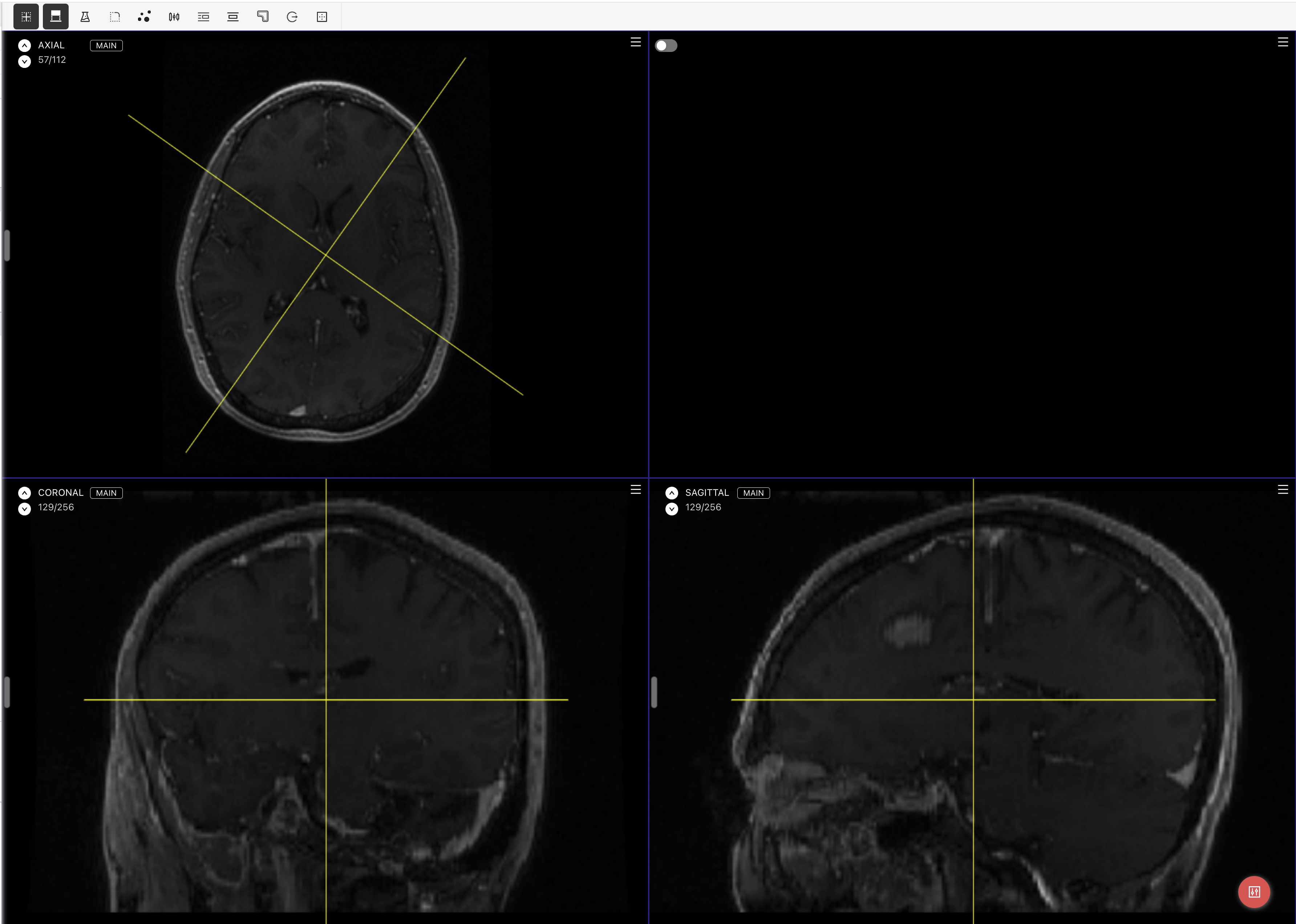 Medical editor showing oblique reformatted planes across Axial, Coronal, and Sagittal views